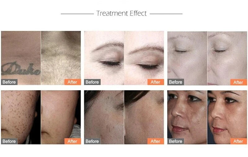 1064/532/1032nm Laser Picosecond Handle ND YAG The Beauty Instrument Accessory for Removing Melanin,Tattoos Cleaning Eyebrows