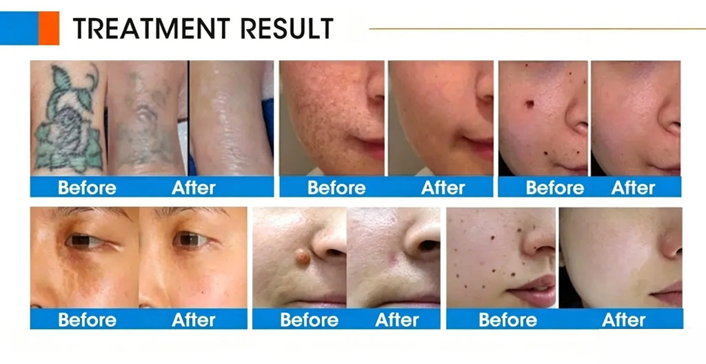 Laser handle 755nm/532nm/1064nm/1320nm Nd:YAG Picosecond Laser Pigment Pico Skin Rejuvenation Machine Handle