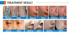 Laser handle 755nm/532nm/1064nm/1320nm Nd:YAG Picosecond Laser Pigment Pico Skin Rejuvenation Machine Handle