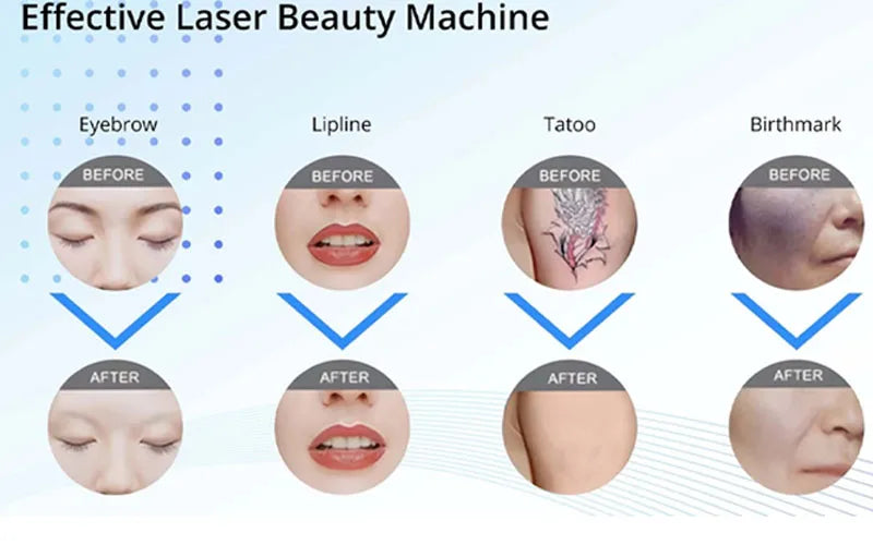 1064/532/1032nm Laser Picosecond Handle ND YAG The Beauty Instrument Accessory for Removing Melanin,Tattoos Cleaning Eyebrows